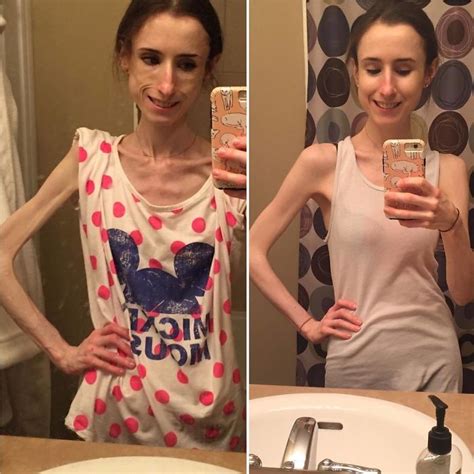 A Journey of Transformation: From Battling Anorexia to Becoming an Icon of Body Positivity